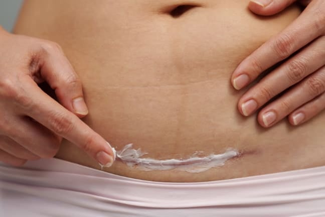 A mother cleaning her C-section scar