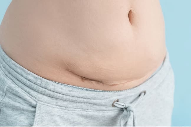 Lower abdomen showing a healed C-section scar and mild overhang during postpartum recovery